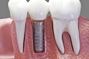 Replace Your Missing Tooth with a Dental Implant