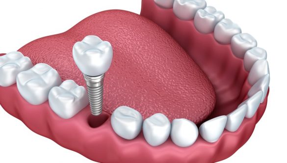 Should You Get Dental Implants OR Bridges?